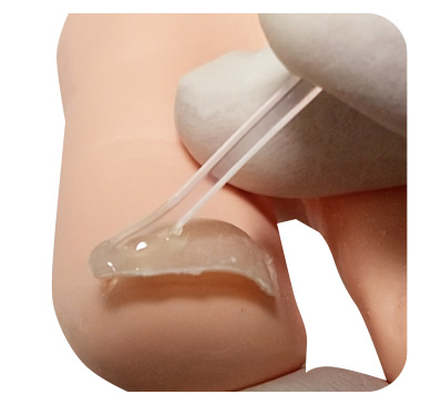 巻き爪の矯正風景